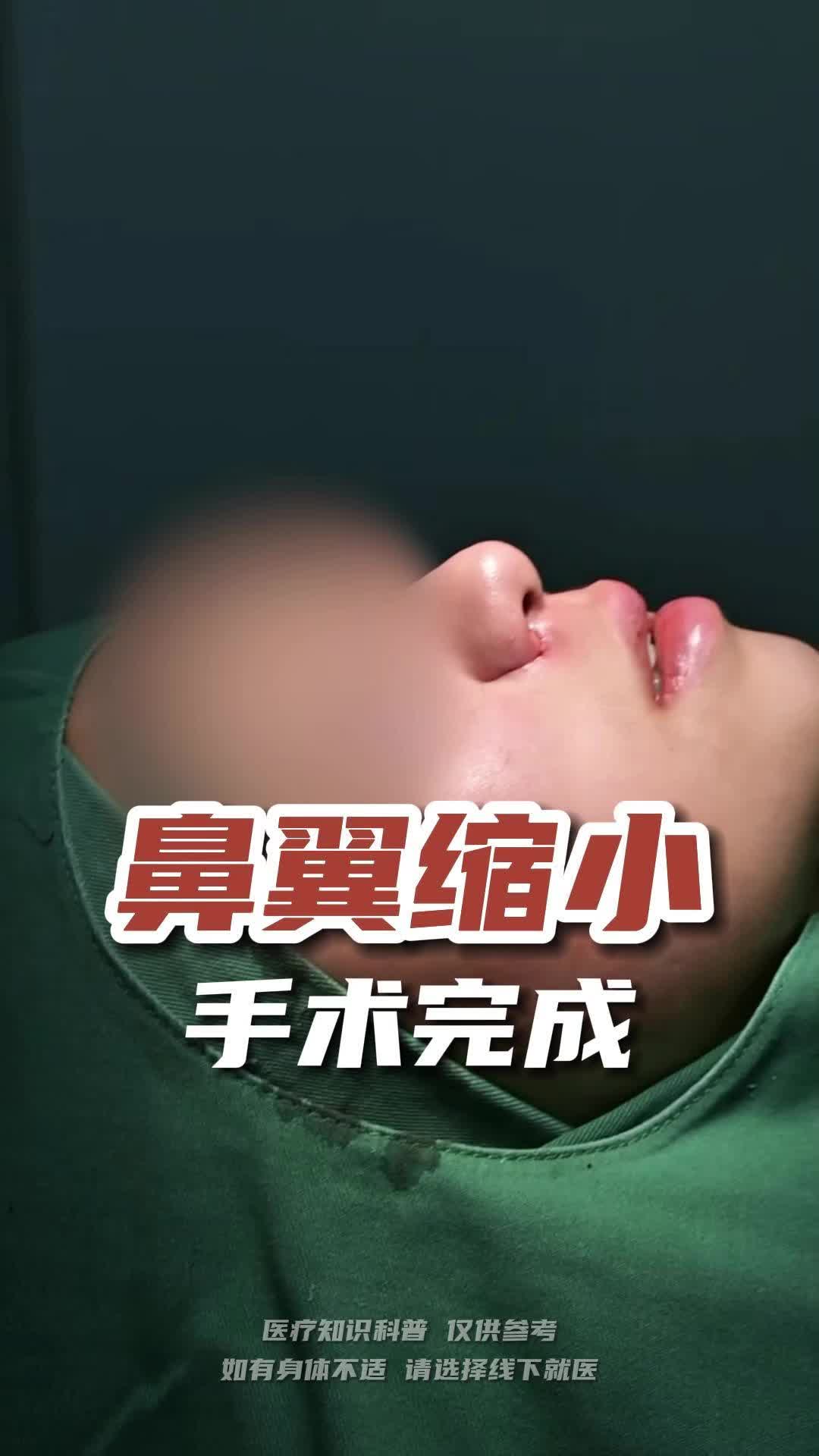 缩小鼻翼有危险么图片