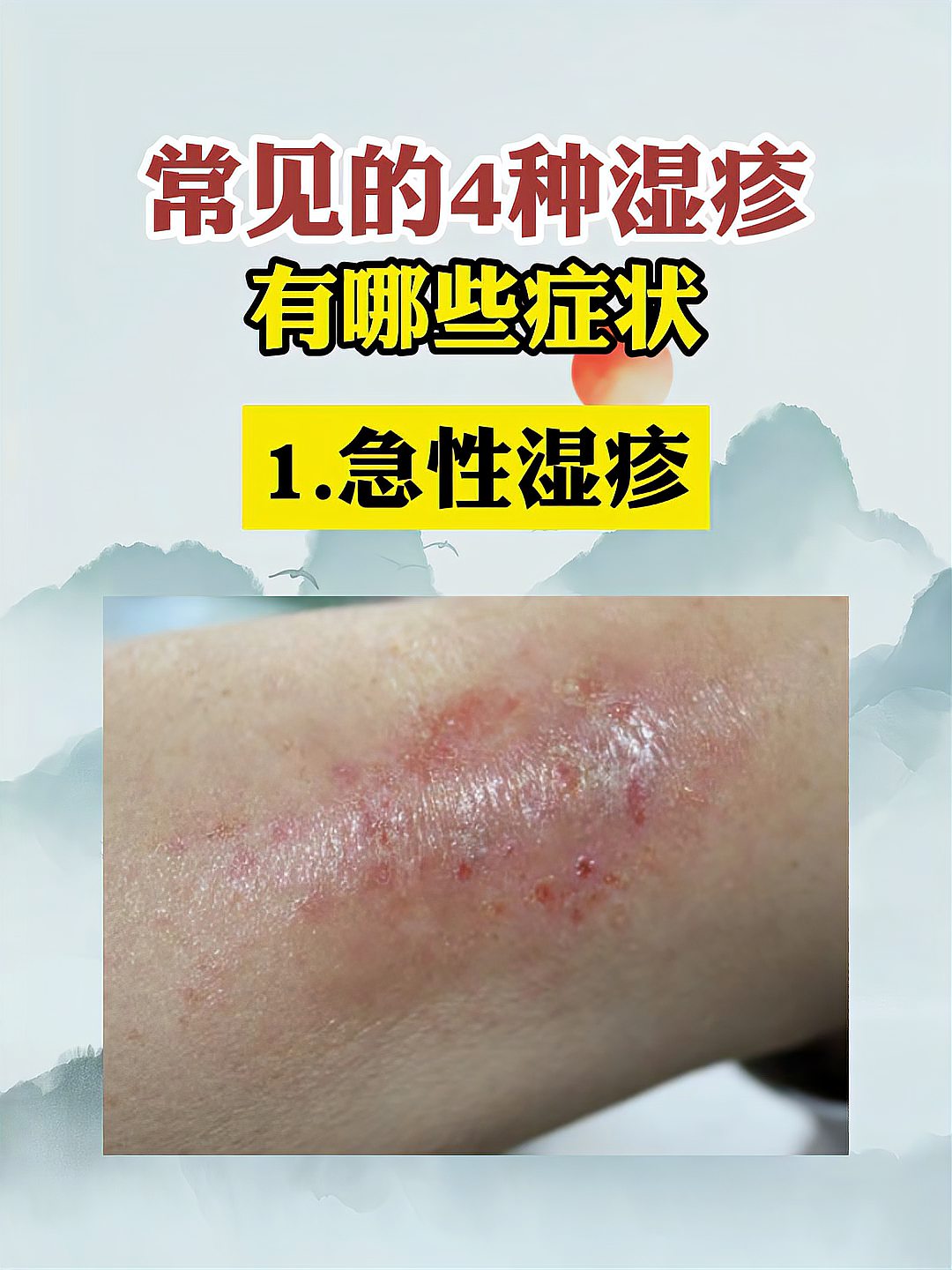 湿疹的症状和表现用什么药膏