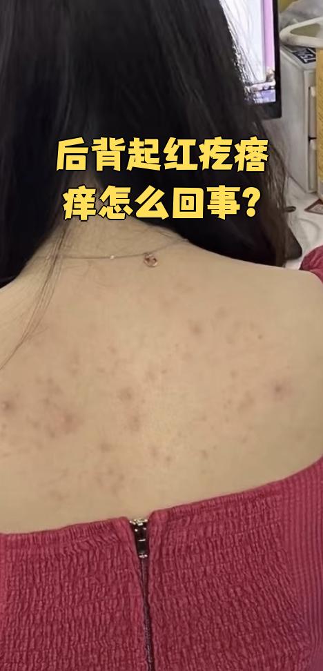 全身起红疙瘩非常痒
