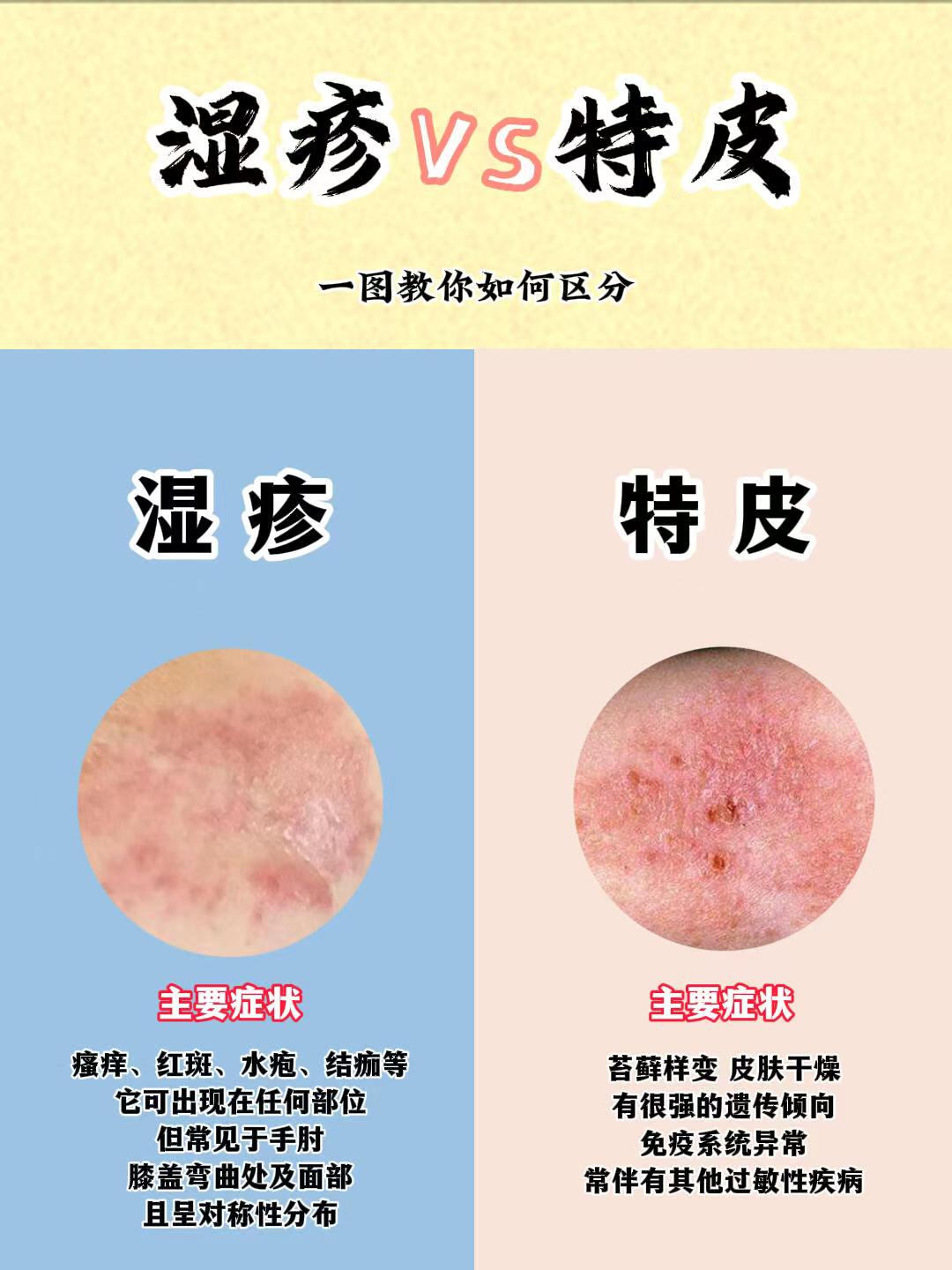 奶藓是湿疹
