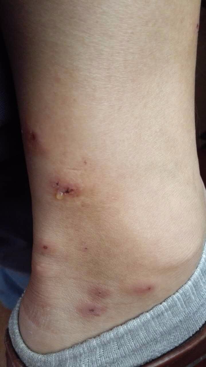 梦到虫子咬我手指很疼