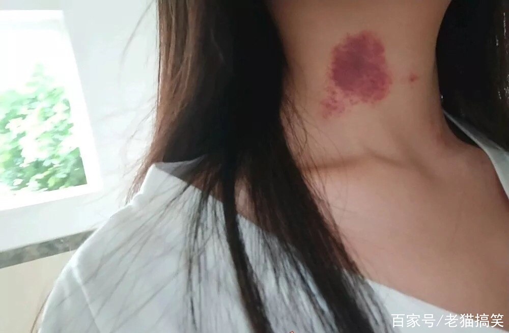 脖子上的草莓印怎么能消除