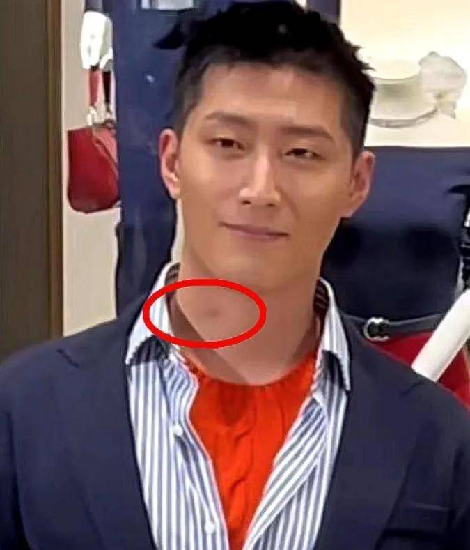 脖子上的草莓怎么形成