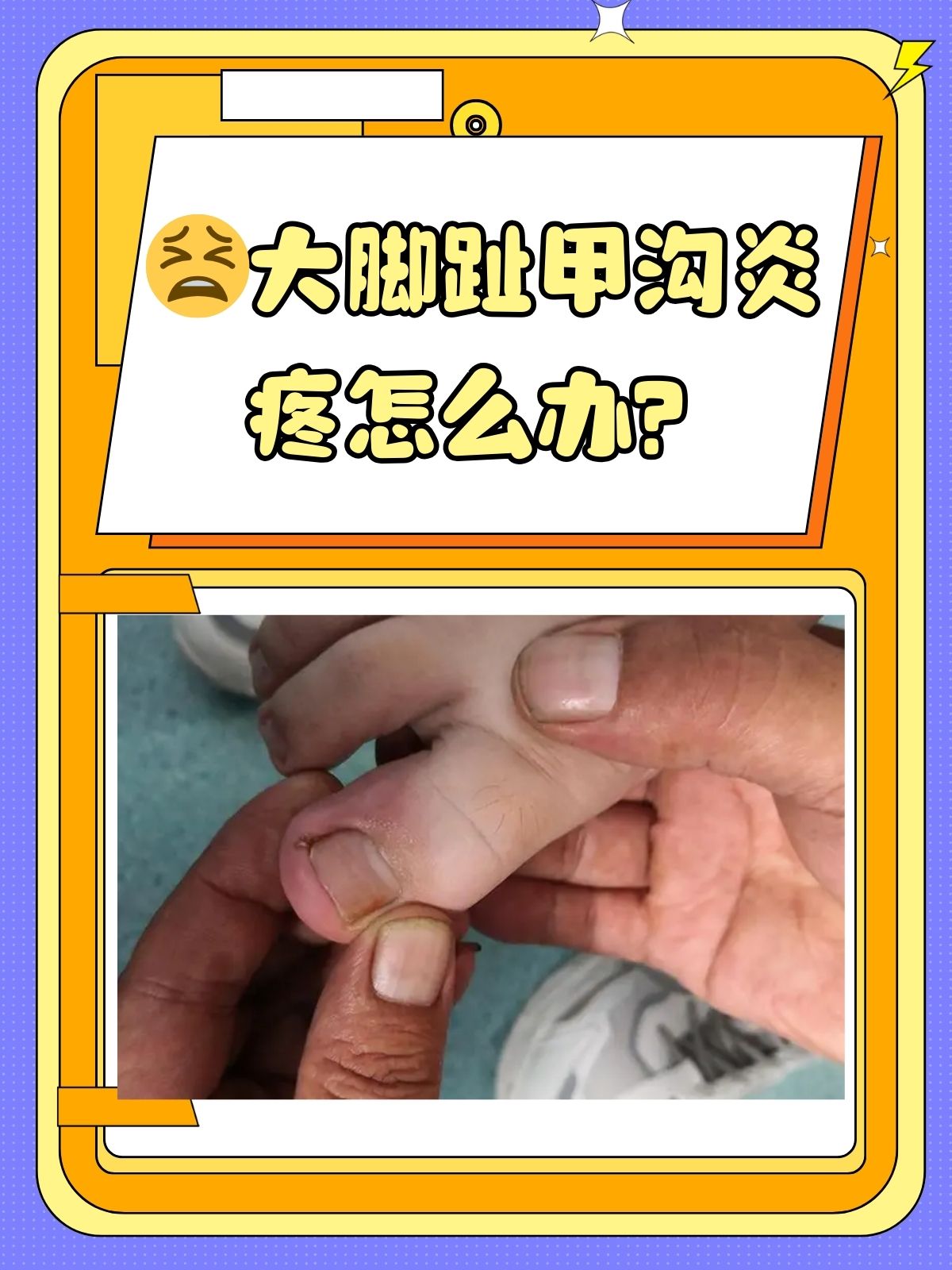 甲沟炎怎么治在家里