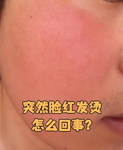 脸又红又烫怎么解决