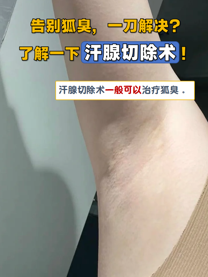 有狐臭的能当兵吗