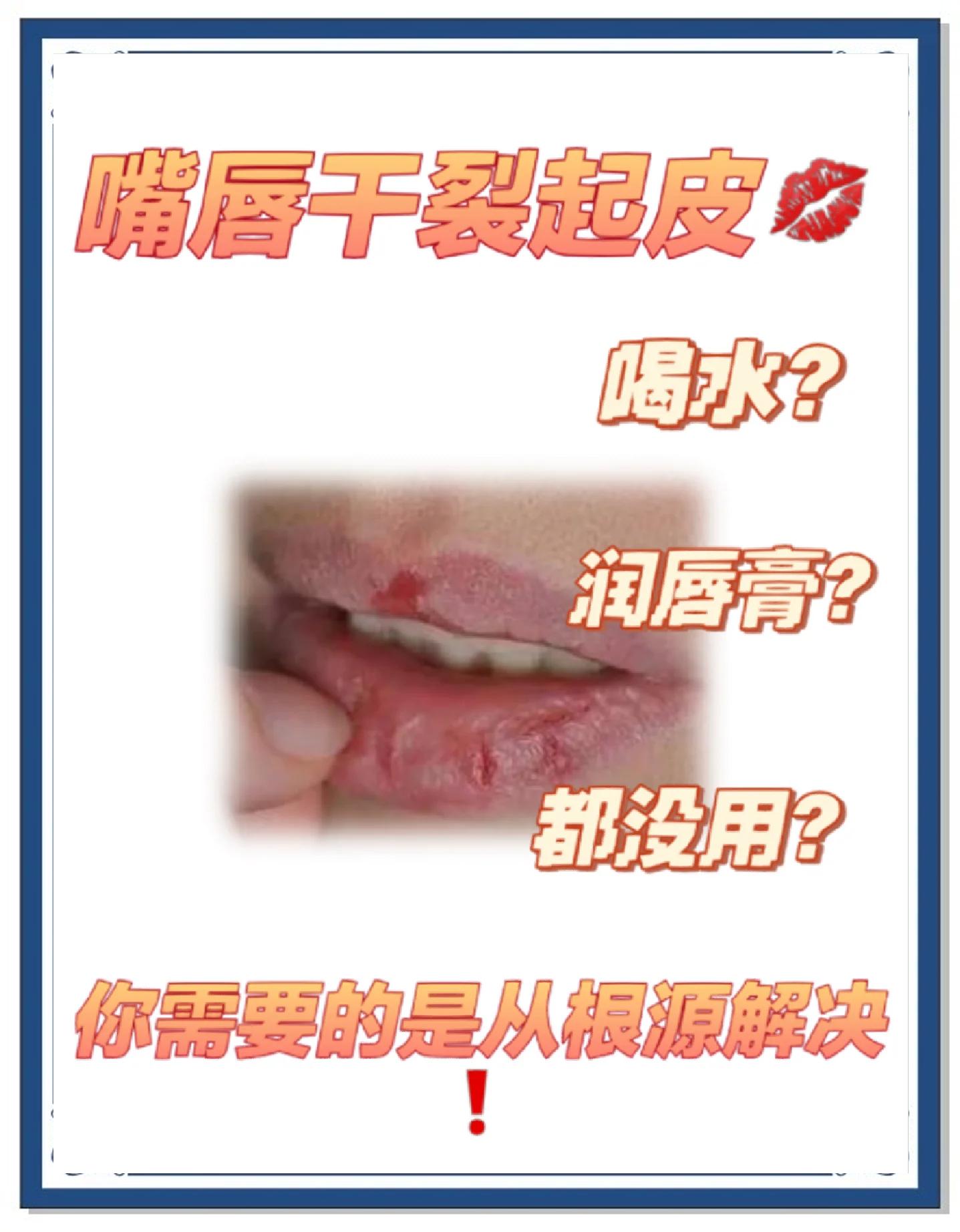 嘴唇褪皮干裂