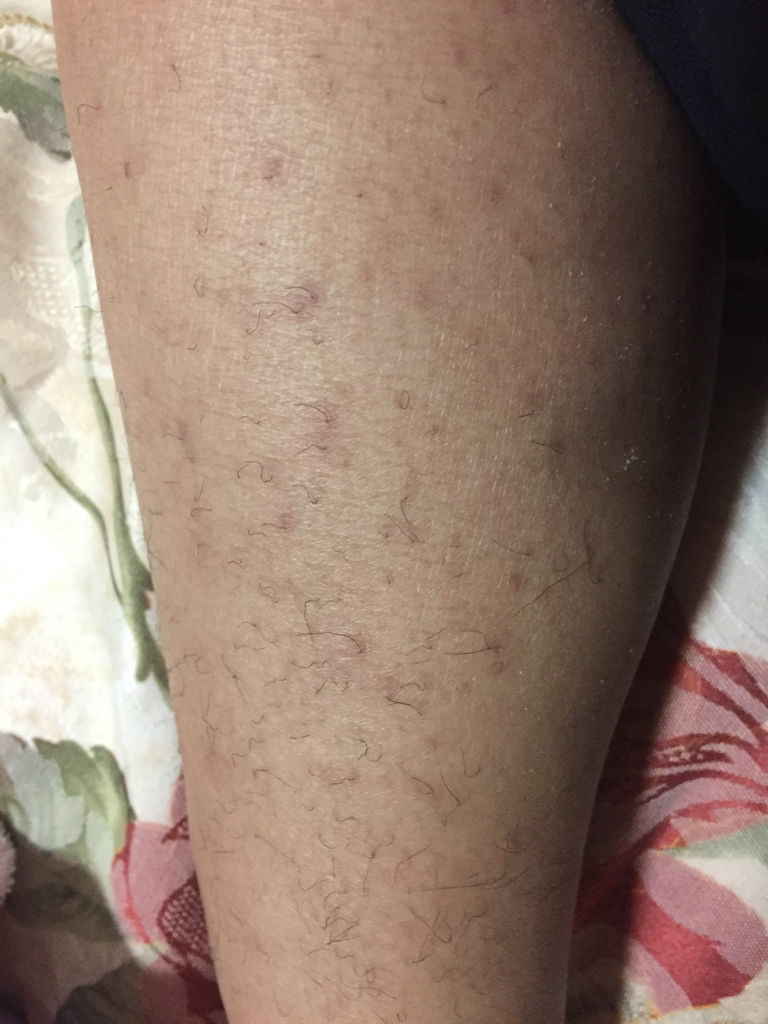 腿上毛孔都是红点点怎么办