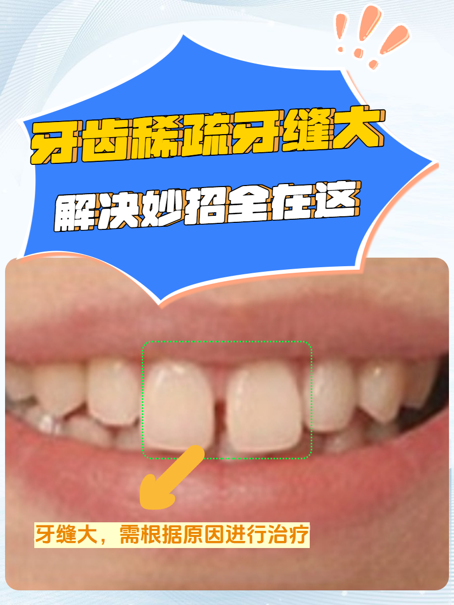 小孩牙齿缝隙大怎么办