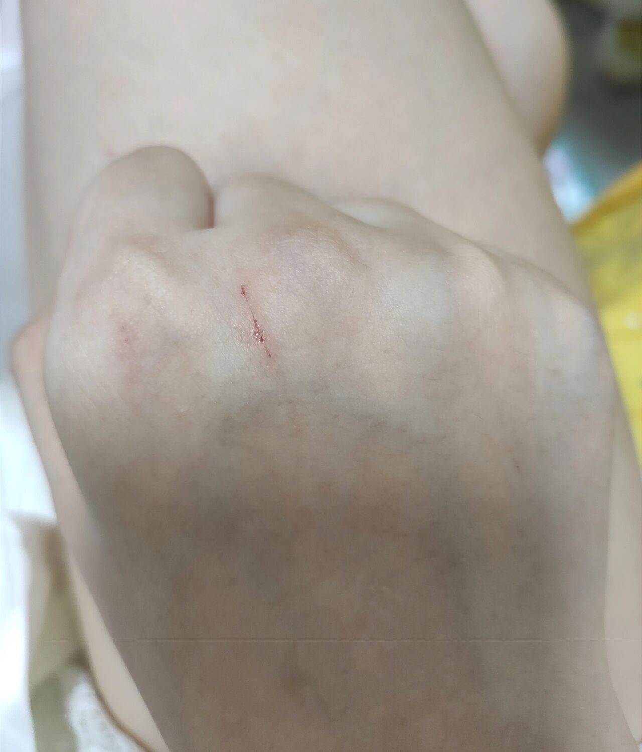 被猫抓了会怎么样一两个月不打疫苗