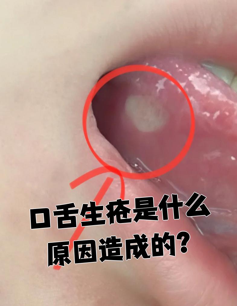 雪口病早期症状图片