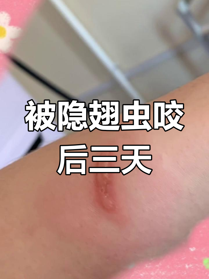 被隐翅虫咬了怎么办用什么药