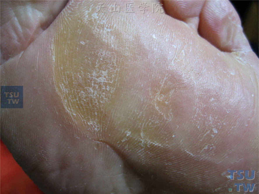 角质层厚重是什么样子的