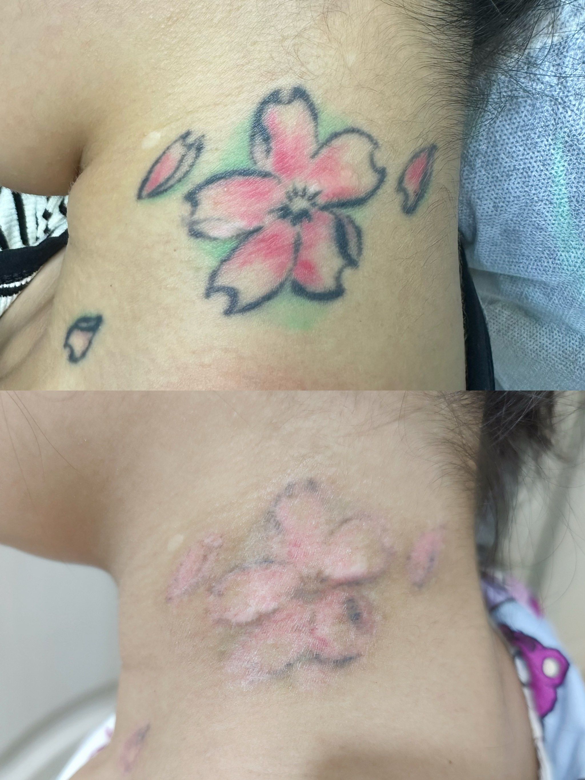 自己怎样去除纹身