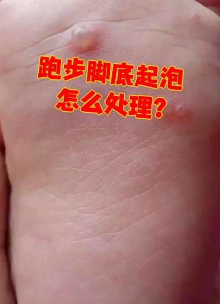 不挑破水泡会不会留疤