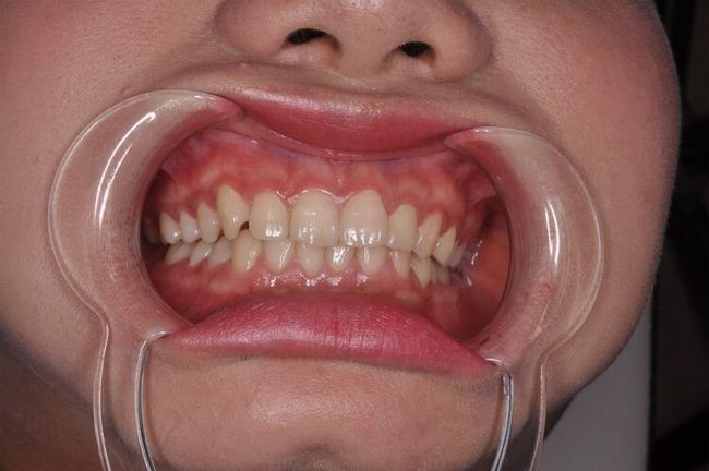 梦见自己牙齿松动即将掉落是什么意思