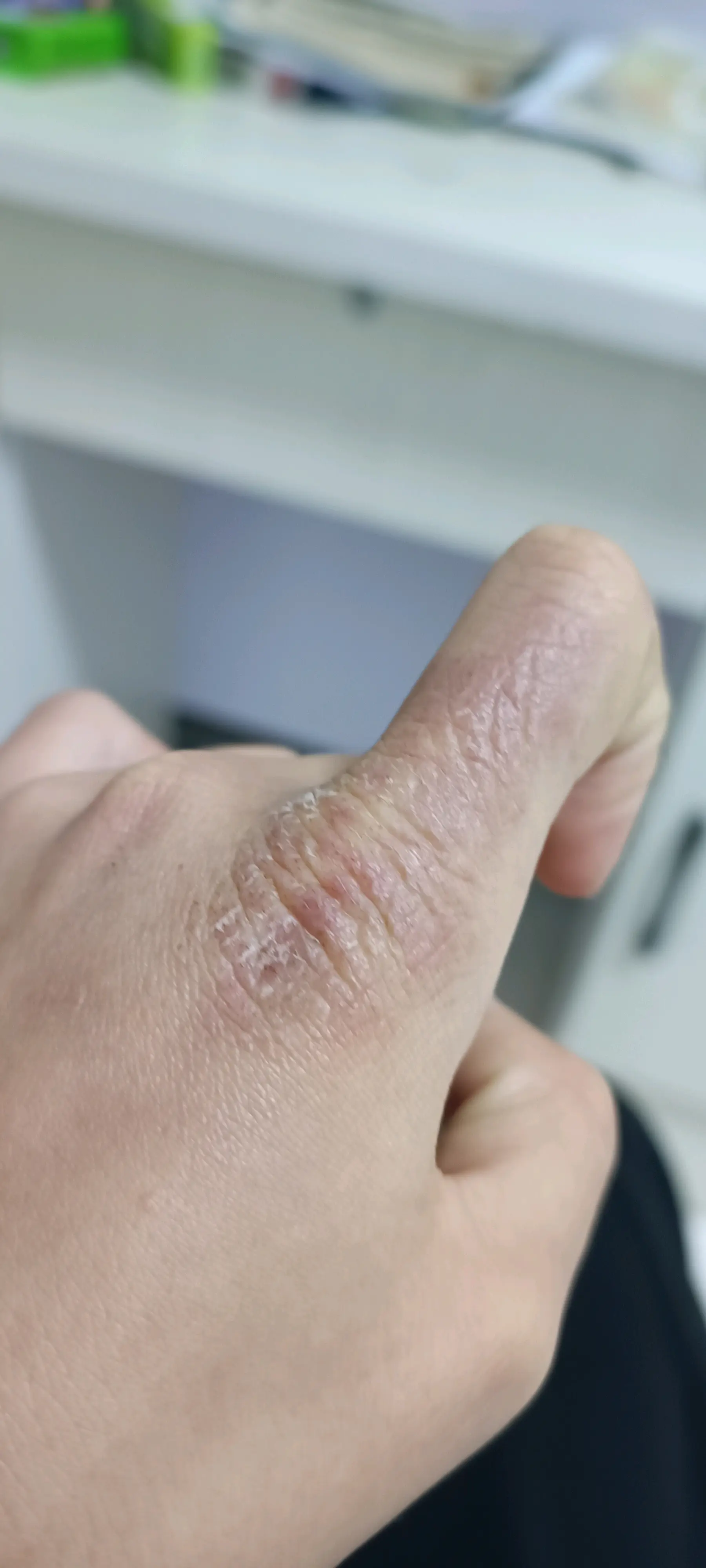 手到冬天就长冻疮